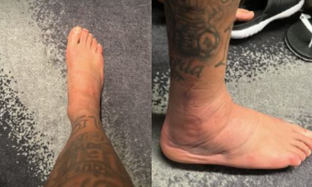 Com pé inchado, Neymar mostra tratamento para se recuperar de lesão; veja