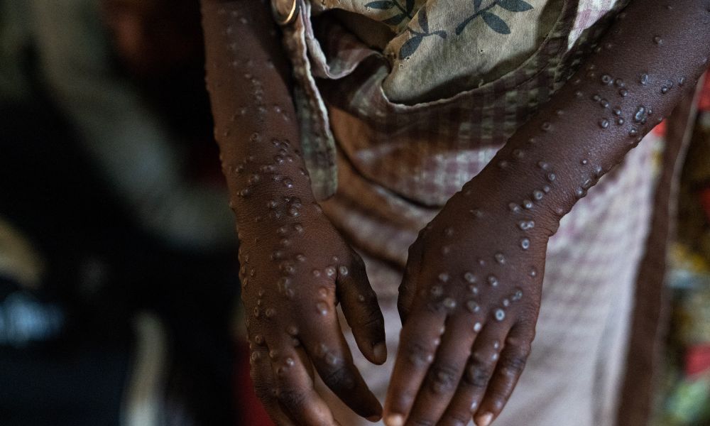 Mpox no Brasil: número de casos confirmados em 2026 sobe para 140