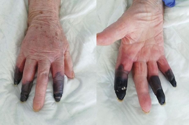 Idosa amputa 3 dedos por causa da Covid-19; veja novos sintomas bizarros da doença