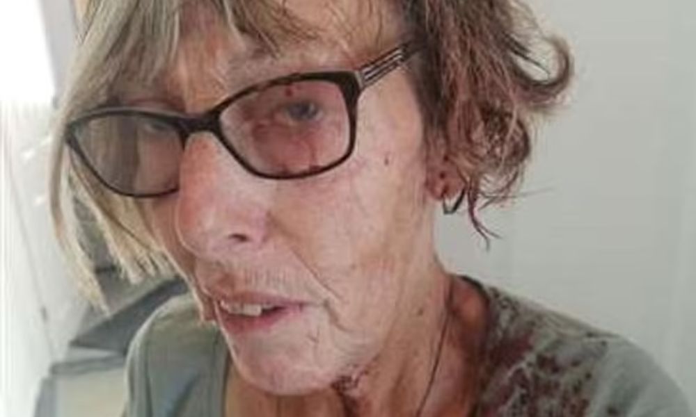 Gaivota ataca senhora de 66 anos e a deixa parecida com ‘personagem de um filme de Freddy Krueger’