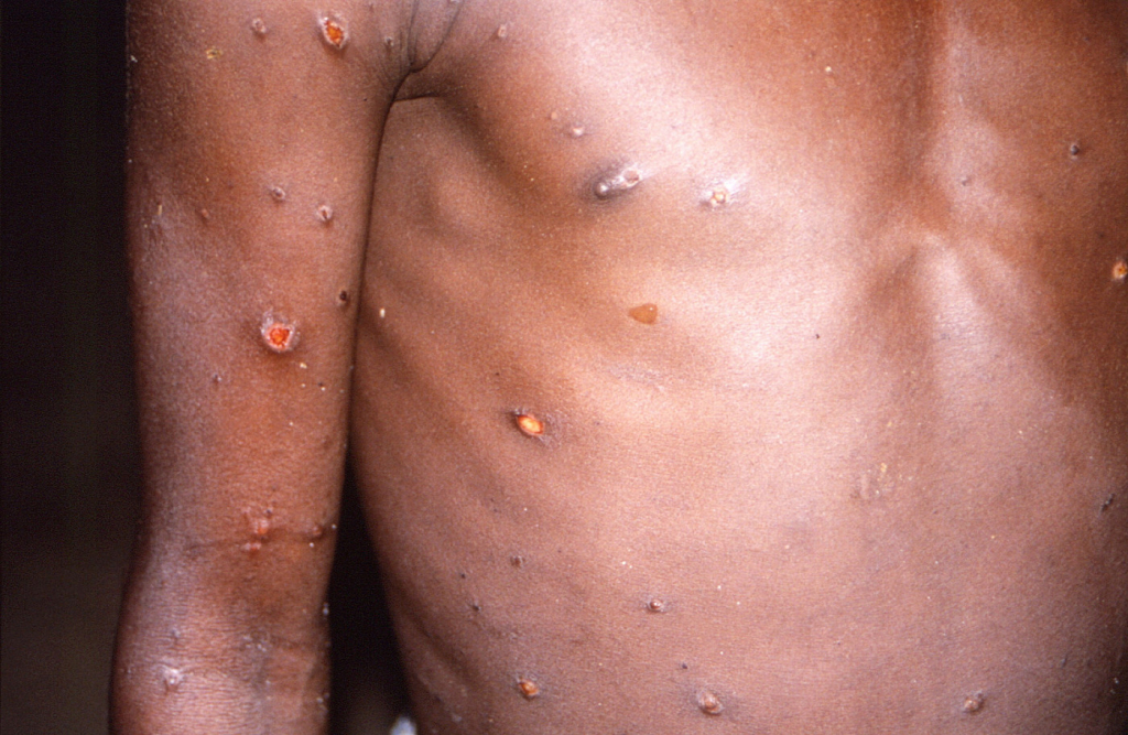 Sete países da África somam 1,4 mil casos de varíola dos macacos em cinco meses