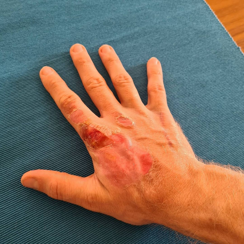 Grosjean mostra mão com queimaduras após acidente na F1 e comemora: ‘50% de volta’
