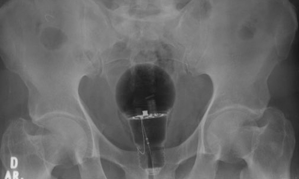 Lâmpada é retirada do ânus de paciente na Colômbia; raio-x choca internautas