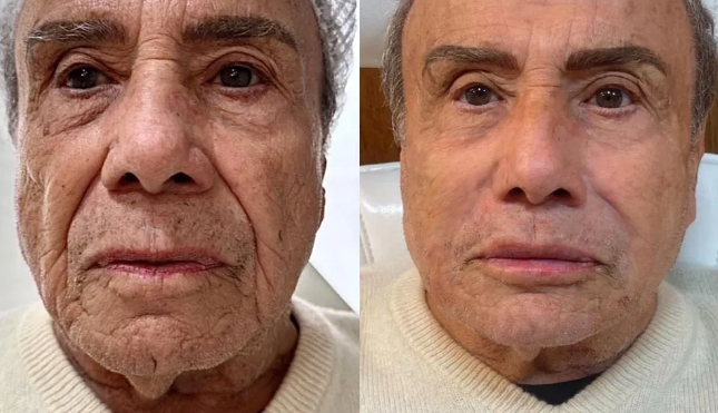 Aos 91 anos, Stênio Garcia faz harmonização facial e comemora: ‘Quinze anos a menos’