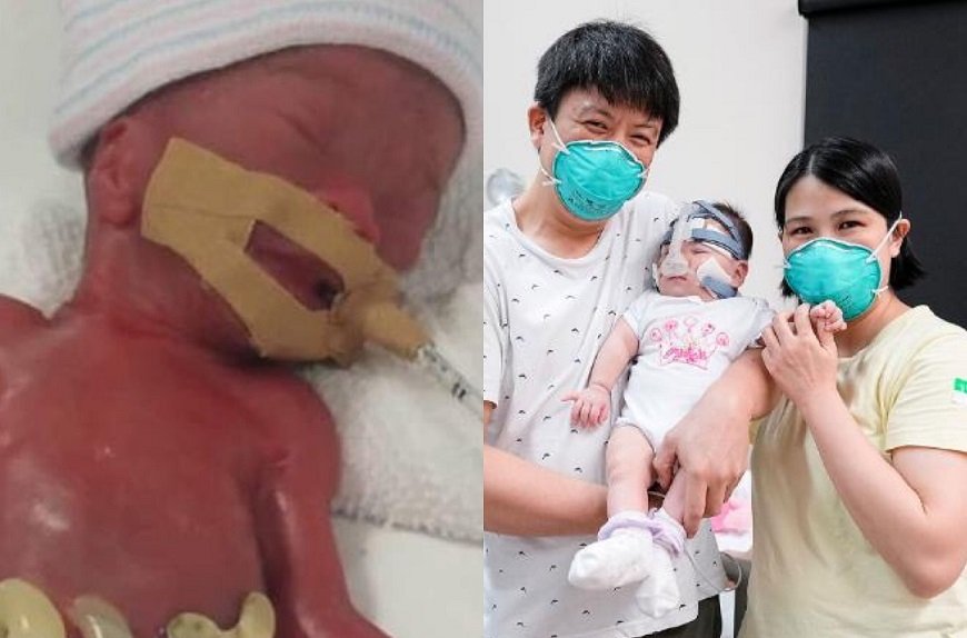 Nascida com 212 gramas, menor bebê do mundo a sobreviver deixa hospital