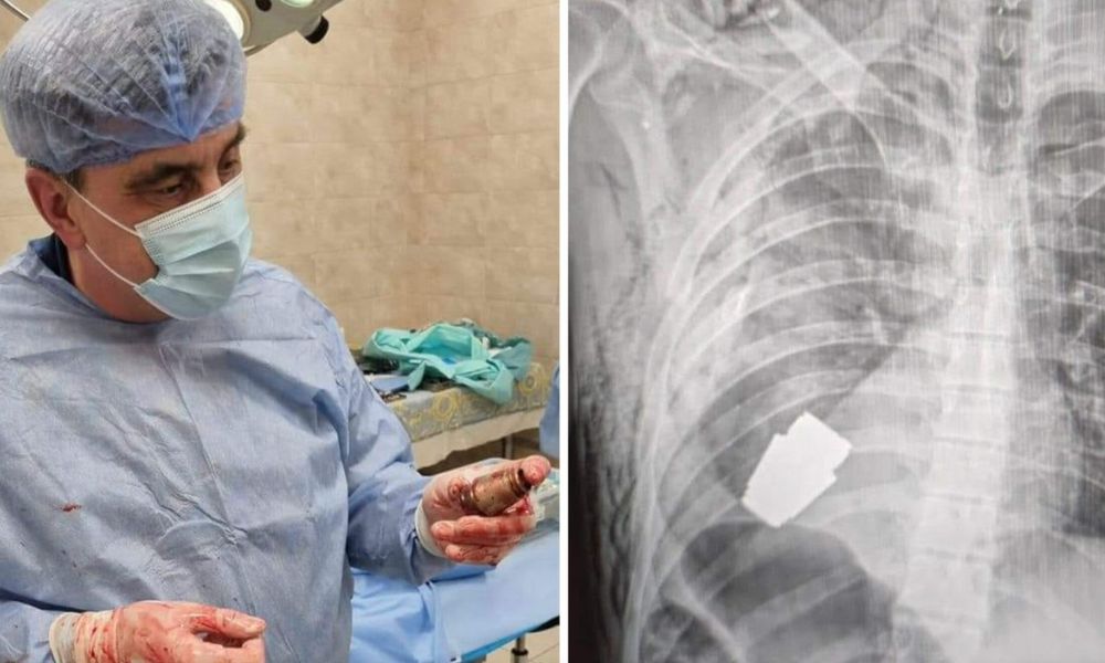 Soldado ucraniano sobrevive a cirurgia para retirar granada ativa presa em seu tórax