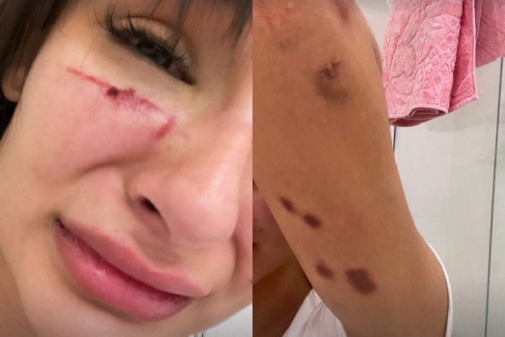 Modelo Anna Figueiredo relata agressão cometida por ex-namorado: ‘Pensei que ia morrer’