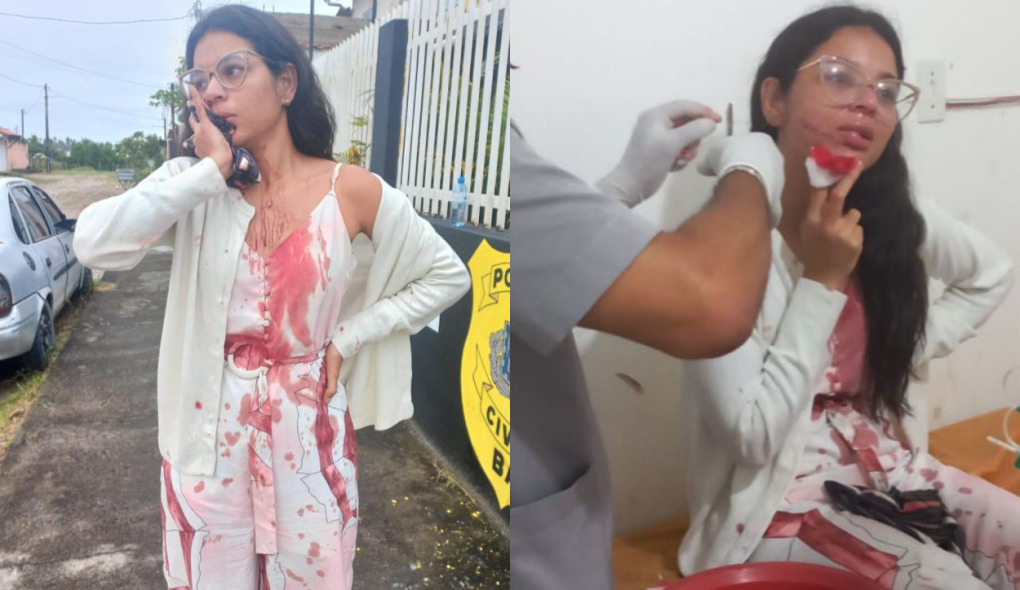 Jovem tem rosto cortado durante viagem de ônibus na Bahia: ‘Violência gratuita’