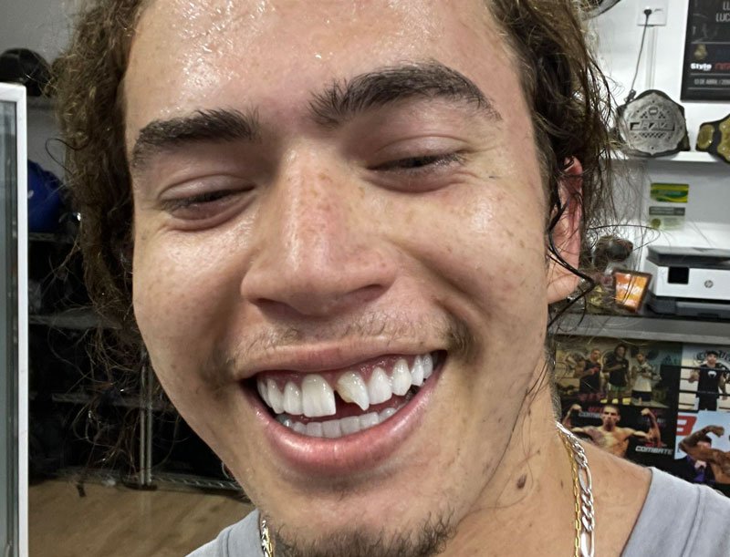 Whindersson Nunes quebra dente após treinar sem proteção: ‘Vacilei’